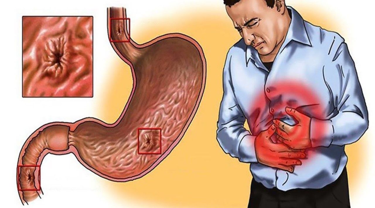 gastrit 1
